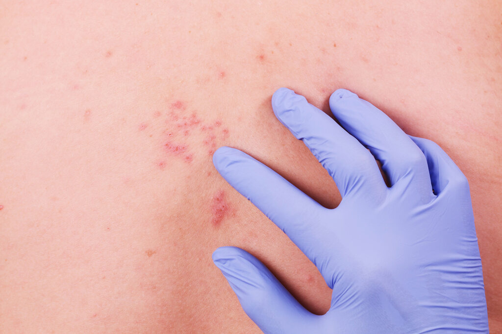 Médico examinando lesão na pele, típica de herpes zoster, para diagnóstico e avaliação.