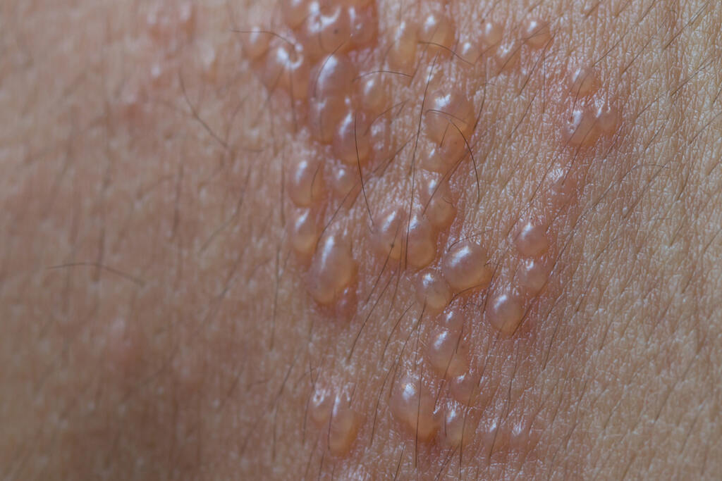 Detalhe de erupções cutâneas e bolhas características do herpes zoster.
