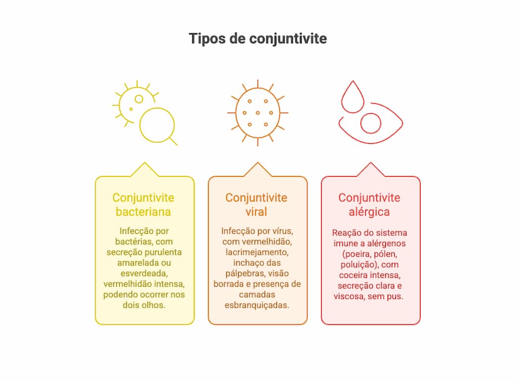 Infográfico com diferenças entre a conjuntivite bacteriana, a conjuntivite viral e a conjuntivite alérgica